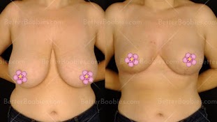 Breast Lift in Turkey