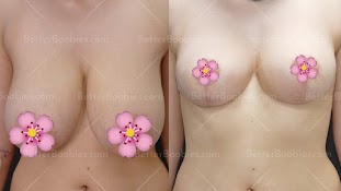 Breast Lift in Turkey