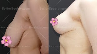 Breast Lift in Turkey