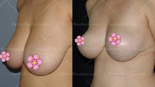 Breast Lift in Turkey