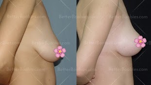 Breast Lift in Turkey