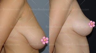 Breast Lift in Turkey